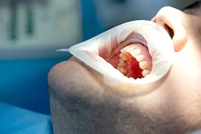Diş taşı oluşumu nedir, tedavi yöntemleri nelerdir?