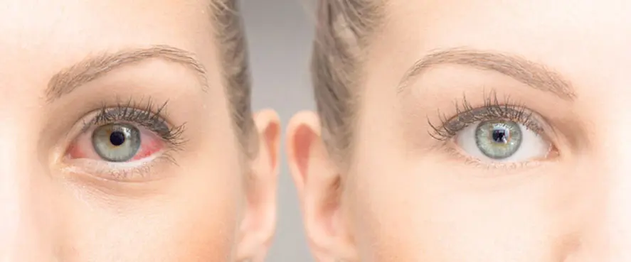 Göz alerjisi kâbusunuz olmasın