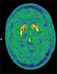 Parkinson tedavisinde umut veren araştırma